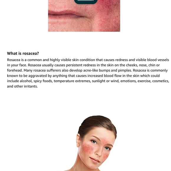 Prosacea Rosacea Treatment Topical Gel - Picture 4 of 7